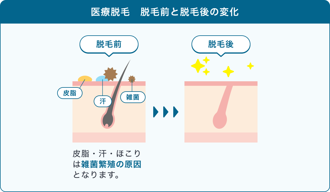 医療脱毛前後の変化